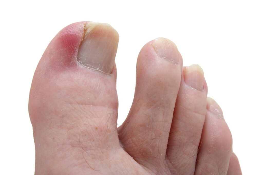 This image has an empty alt attribute; its file name is iStock-182510082-Ingrown-toenail-2-1024x683.jpg